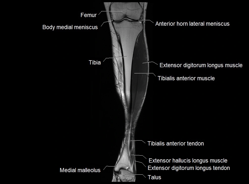 MRI 3T leg (tibia & fibula) labelled coronal cross sectional anatomy image 11.webp